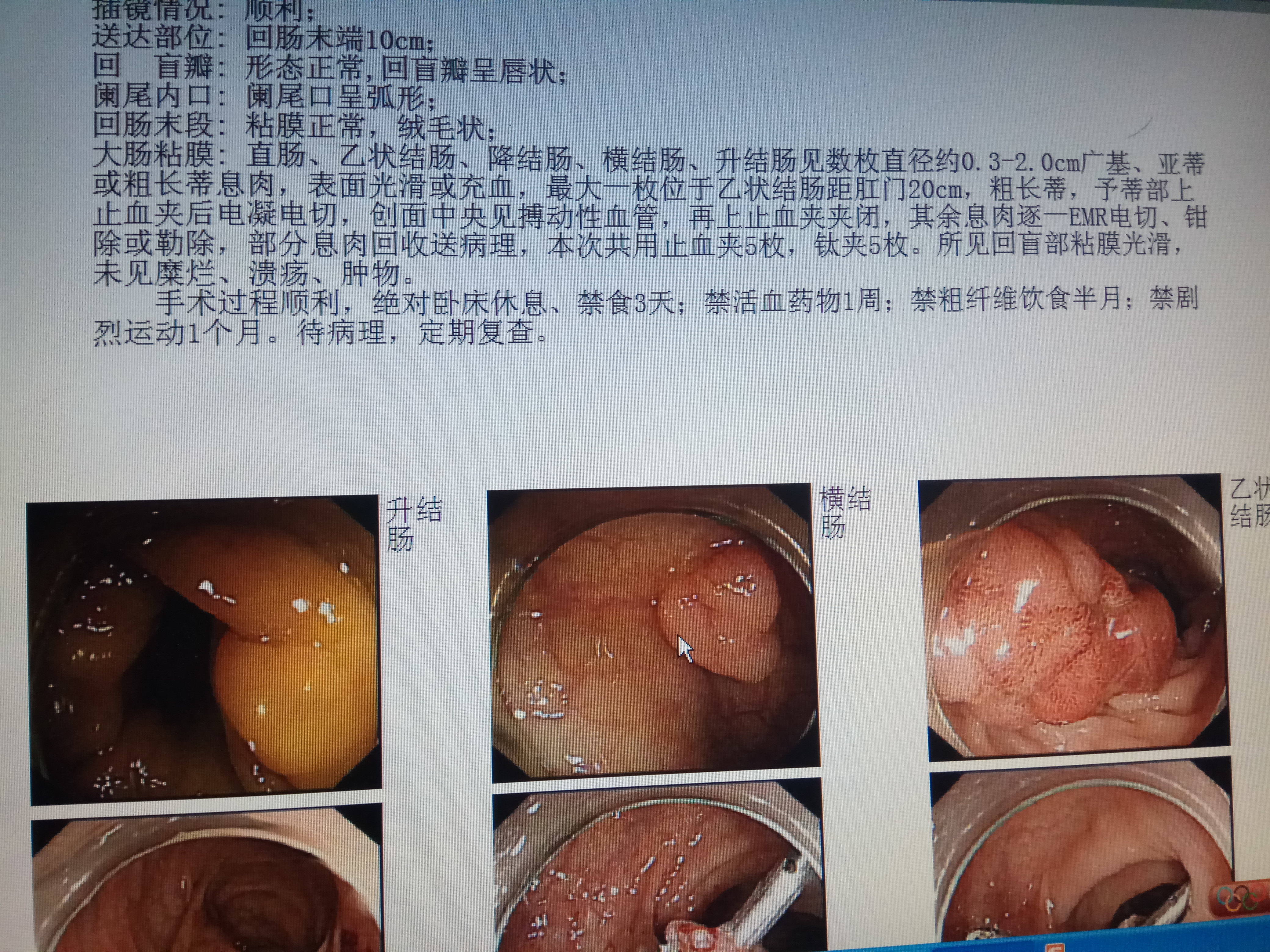 肛周脓肿治疗新术式探析